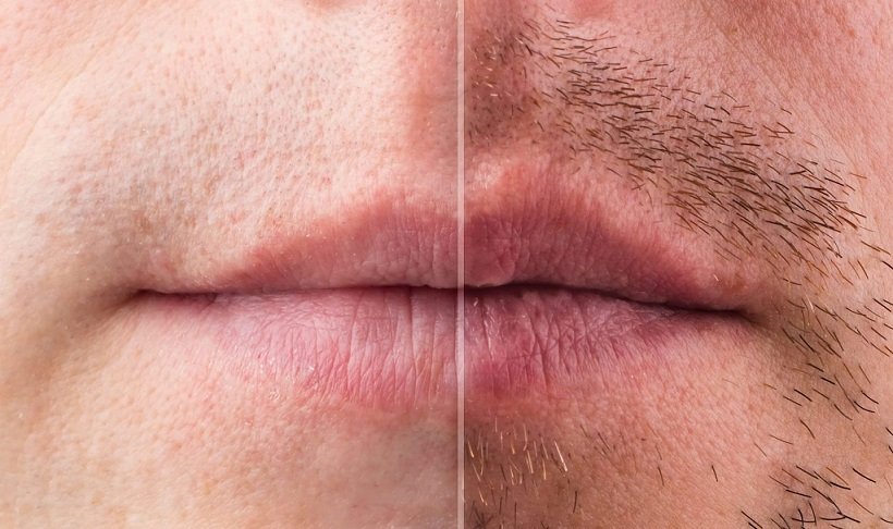 Mustache Hair Transplant Financing in Dubai